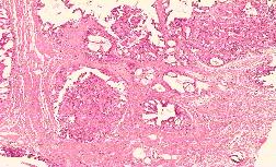 Breast Biopsy Sample