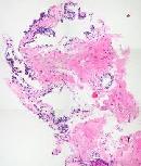 Prostate Biopsy Sample