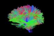 Diffusion tensor imaging (DTI) scan