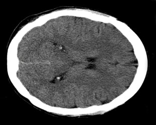 Labeled anomalies in a brain CT scan