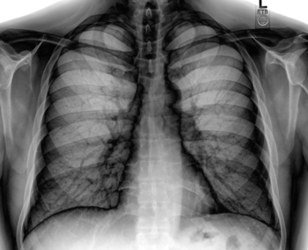 Chest radiograph