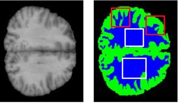 Brain MRI tissue segmentation